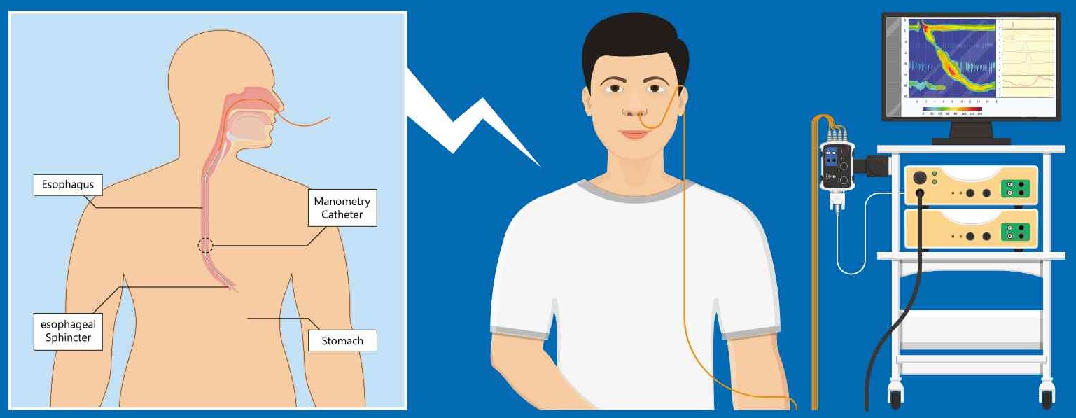 Esophageal Manometry- Procedure, Benefits, Risks and Result